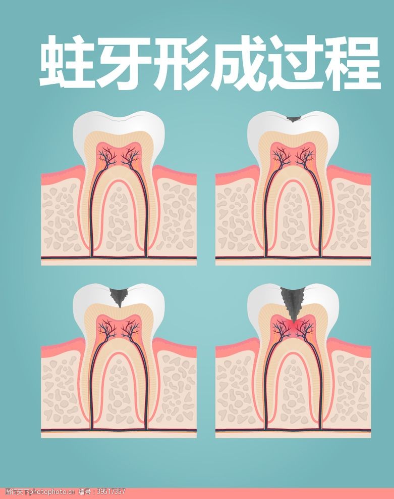 疗程蛀牙的形成过程图片