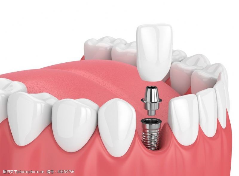 种植牙照片图片